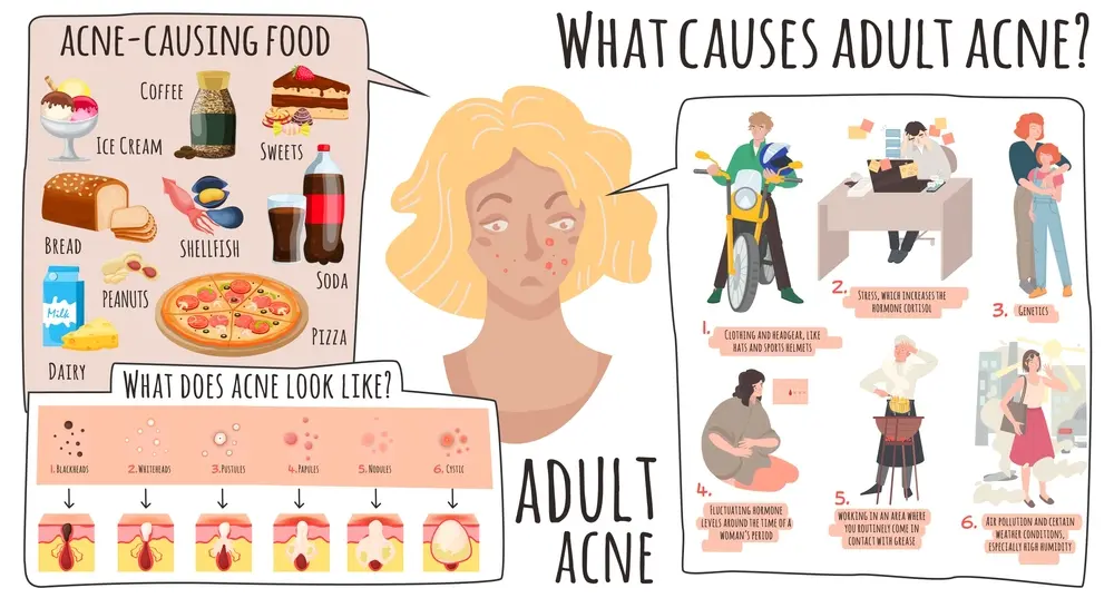 What-Causes-Adult-Acne