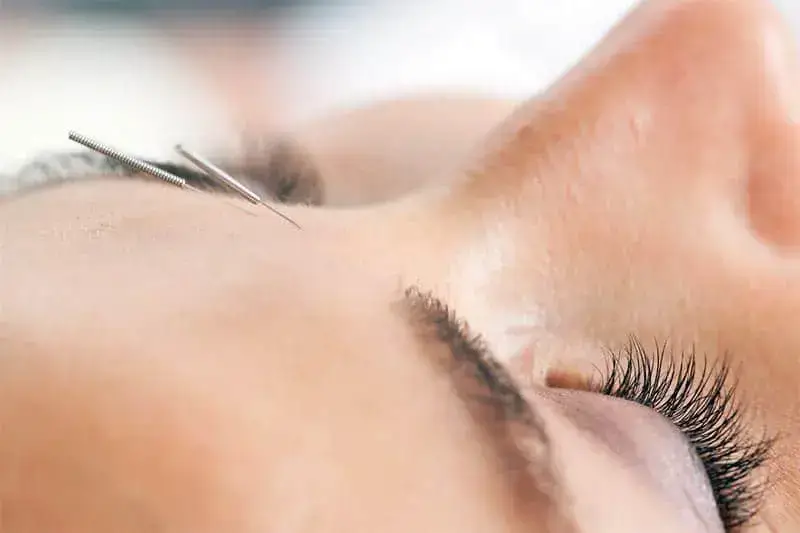 Cosmetic Acupuncture