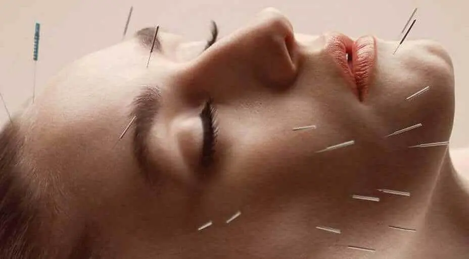 Benefits of Cosmetic Acupuncture