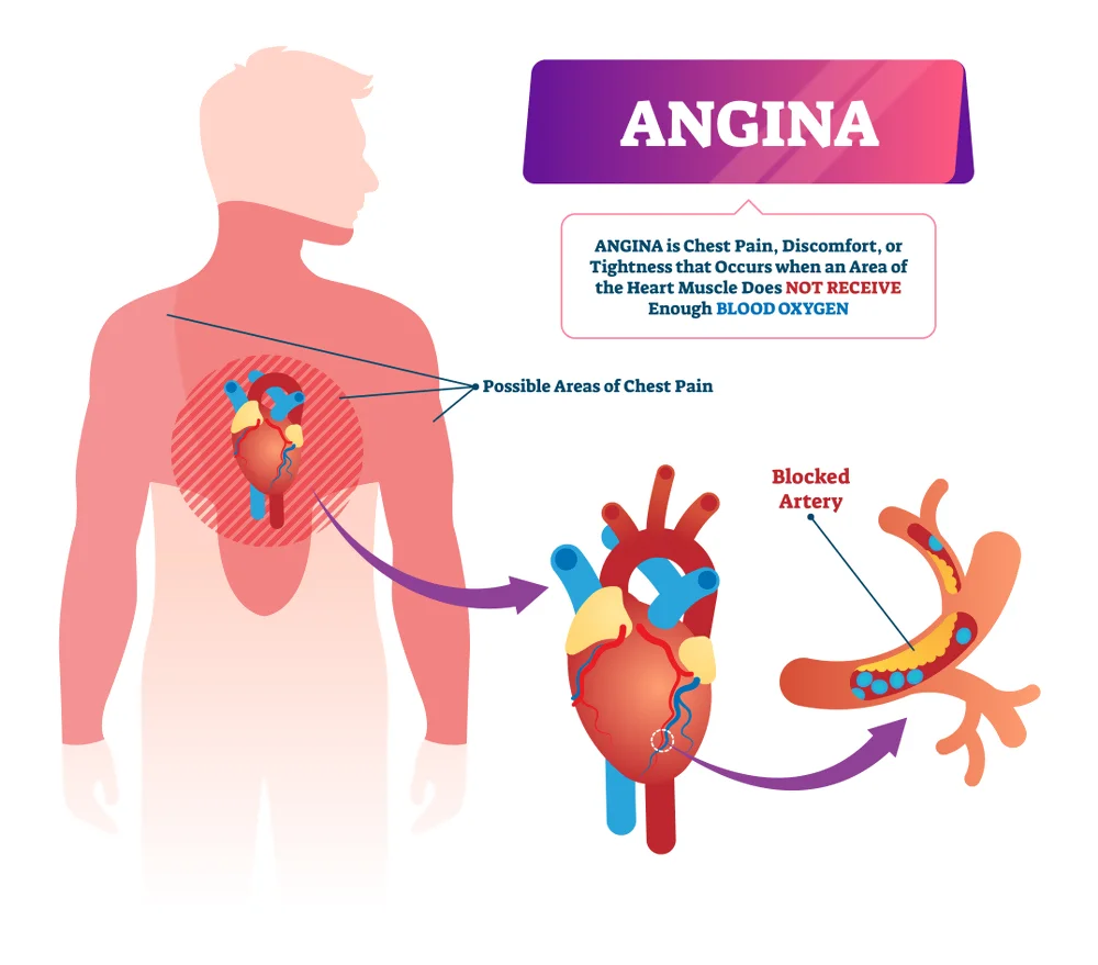 Angina Treatment