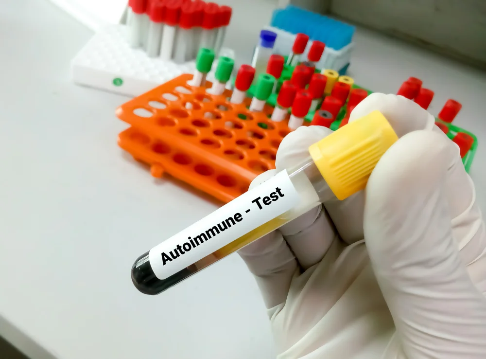 Autoimmune Test