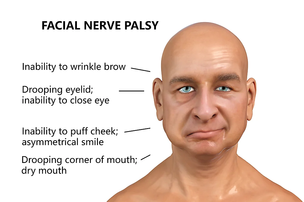 Bells Palsy Facial Nerve Paralysis
