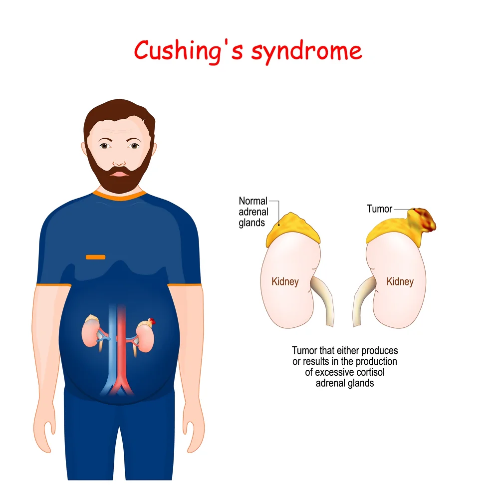 Cushings syndrome - High Cortisol