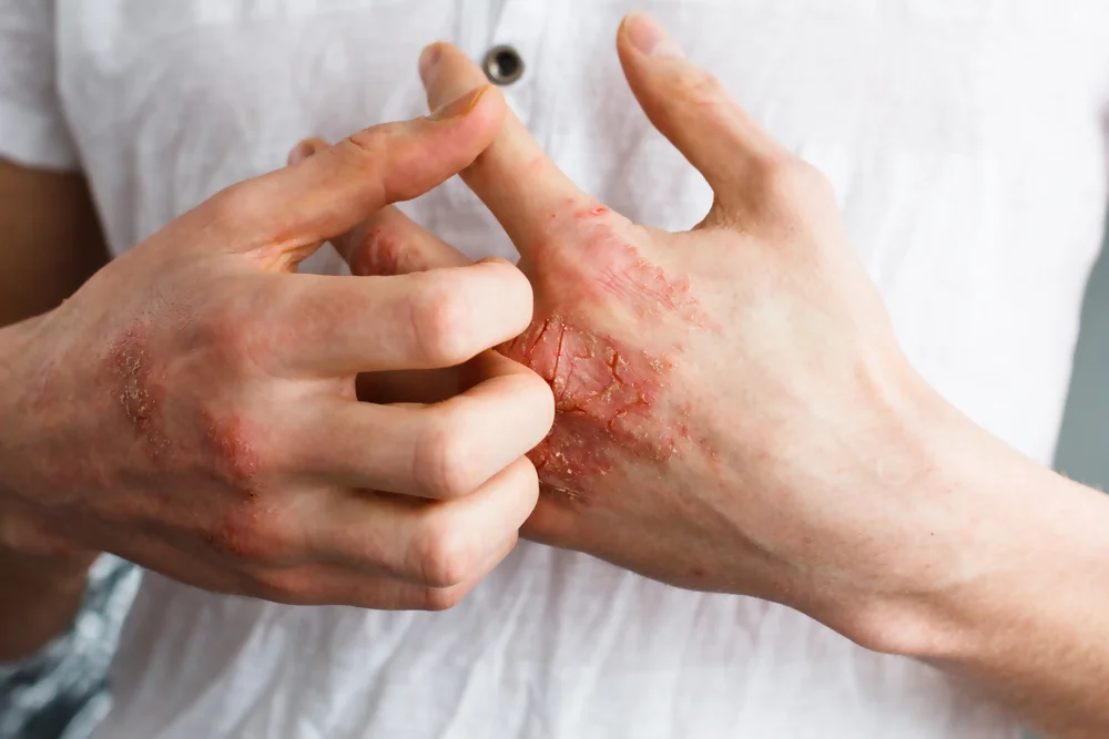Dermatitis, Skin Allergies, Eczema
