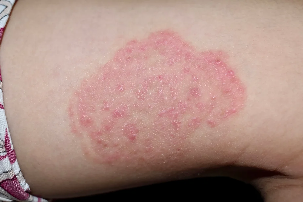 Fungal Infections – Tinea (ringworm)
