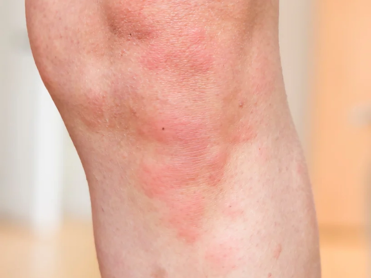 Hives, Skin Rash, Skin Allergies • Oakville • Naturopath • Natural Health Clinic of Halton