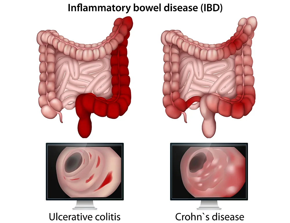 Inflammatory Bowel Disease - Crohn’s disease and Ulcerative colitis