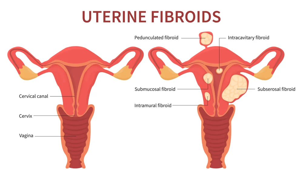 Uterine fibroids and back pain