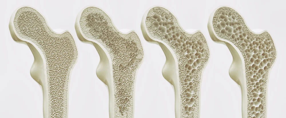 four-stages-osteoporosis