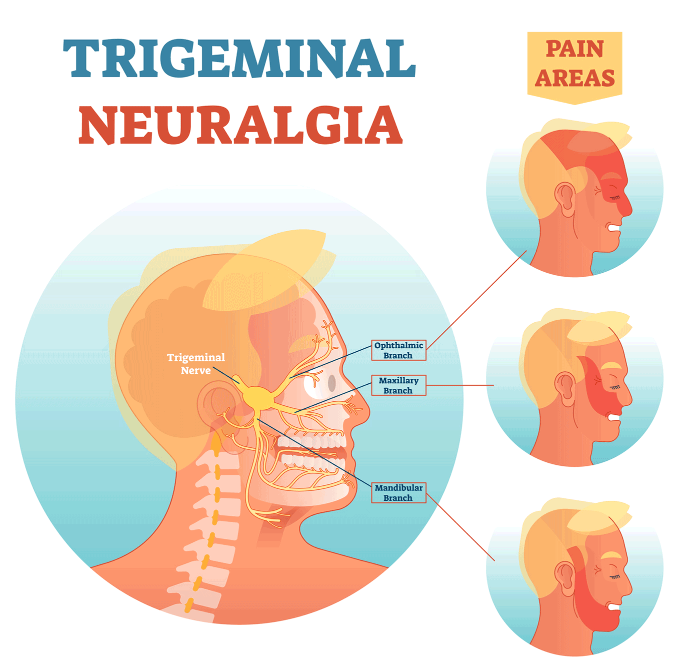 trigeminal-neuralgia-nerves