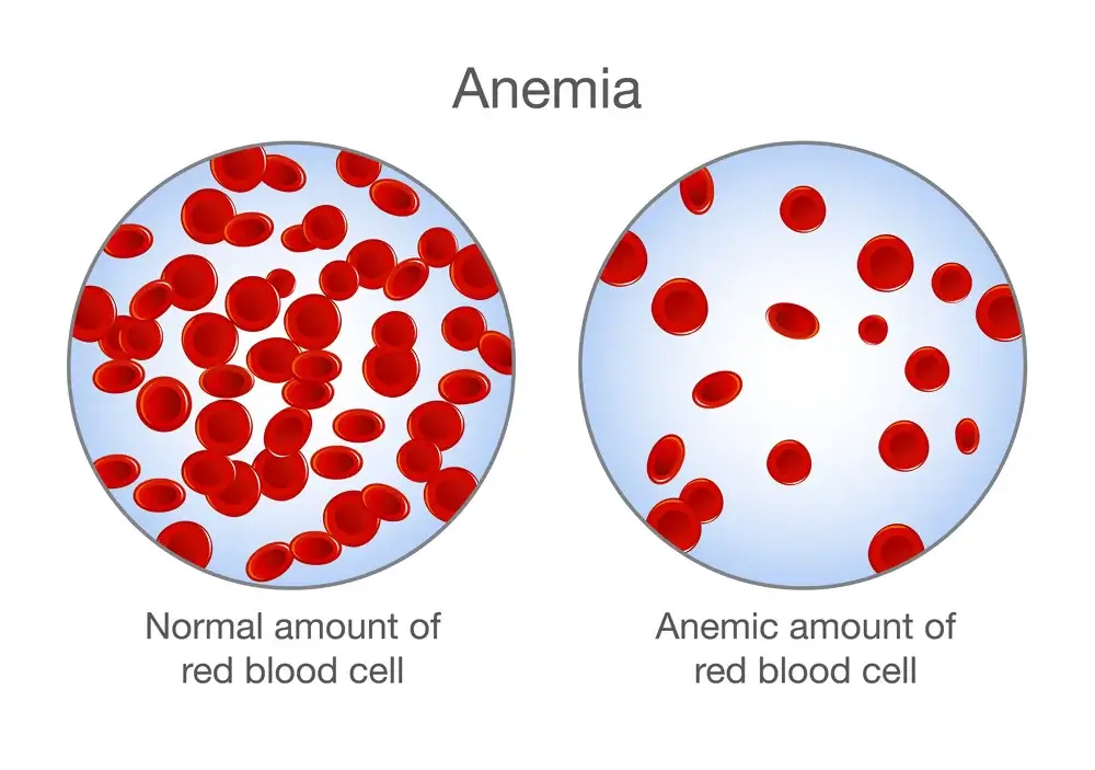 Anemia treatment