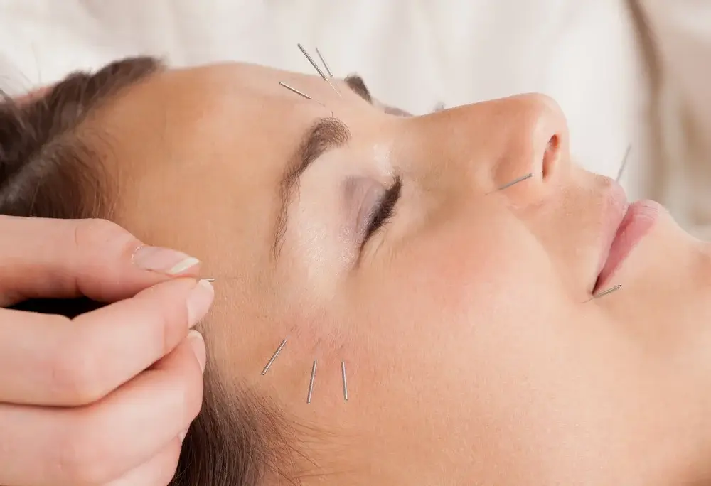 cosmetic-acupuncture