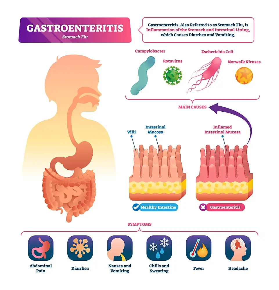Gastroenteritis