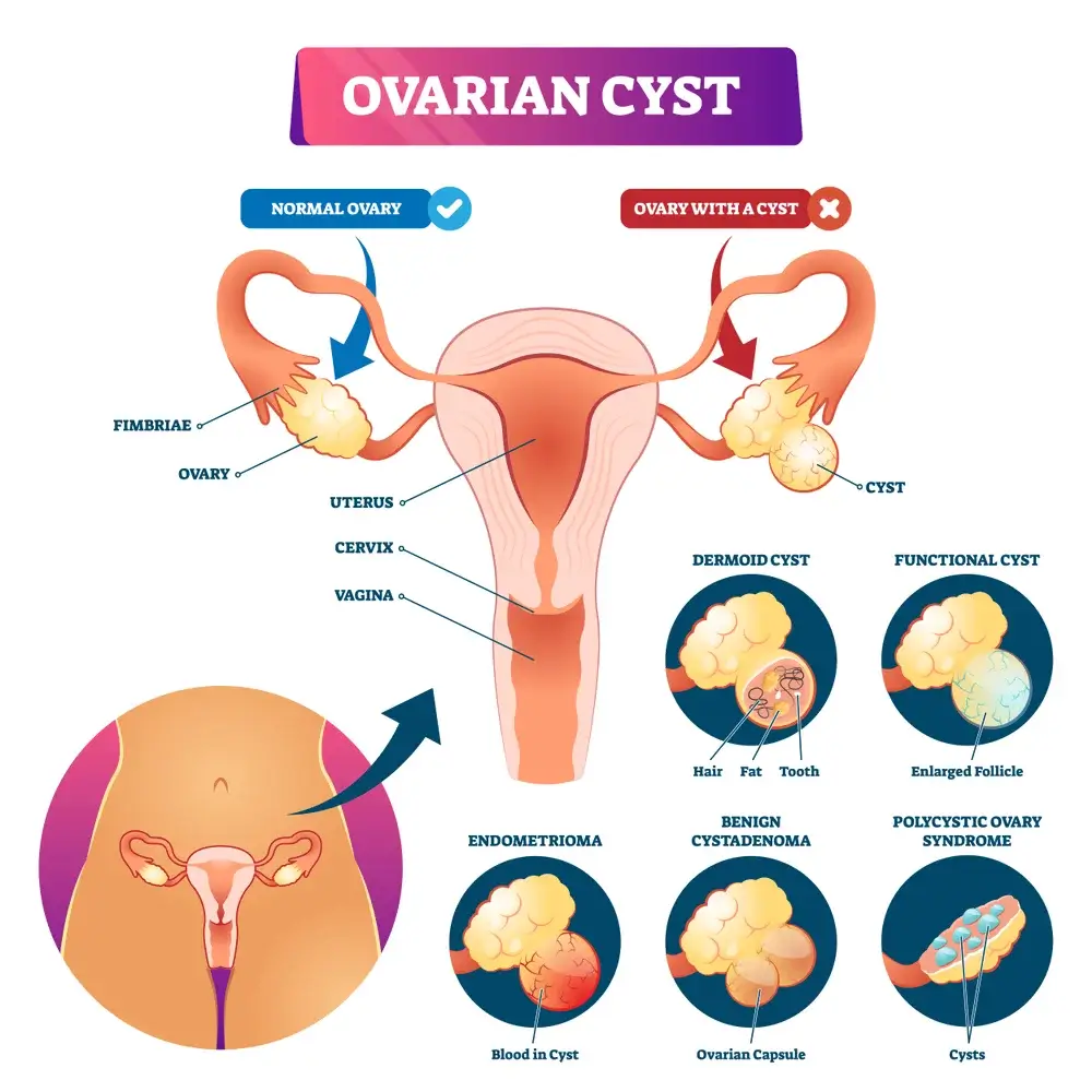 Ovarian-Cyst