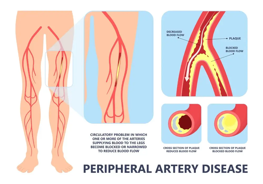 Peripheral Artery Disease