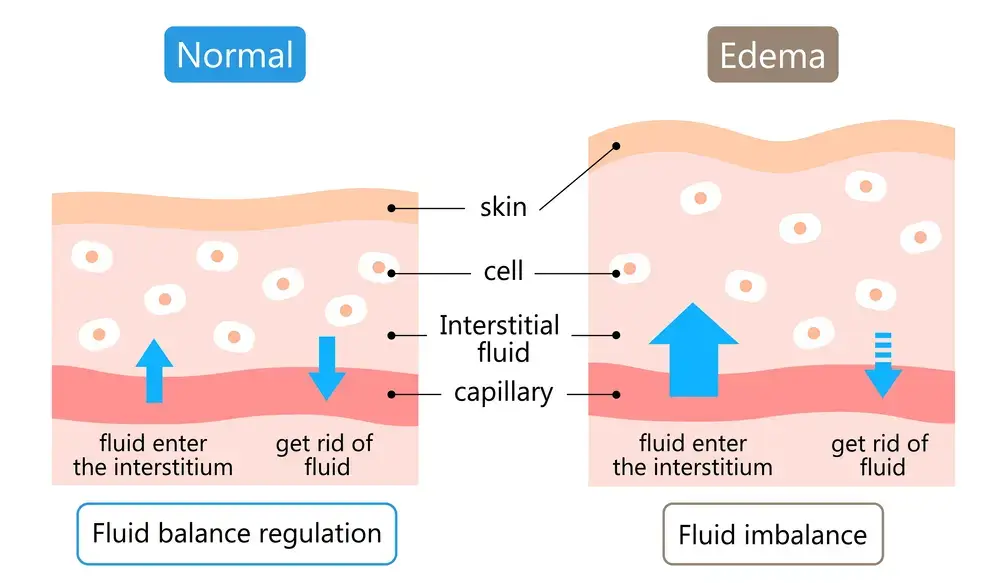 Edema-Symptoms