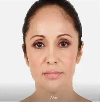 Juvederm-after