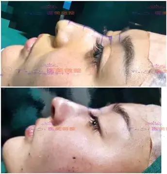 Thread-rhinoplasty-2
