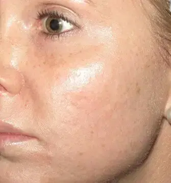 platelet-rich-plasma-after