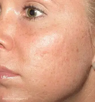 platelet-rich-plasma-before