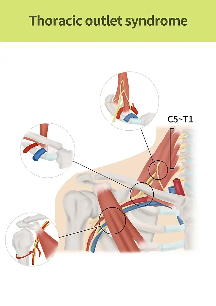 Thoracic Outlet Syndrome